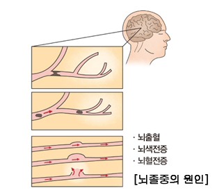 뇌졸중(중풍) 이란?