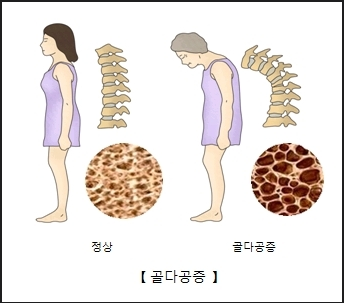 골다공증이란?